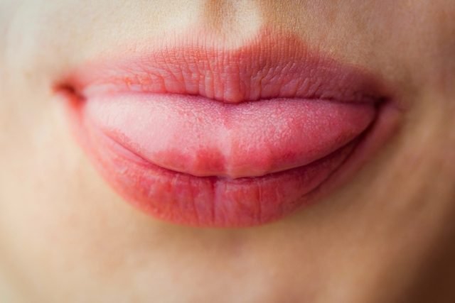 Sapinho: principais sintomas e como tratar a candidíase oral - Dani-se ...